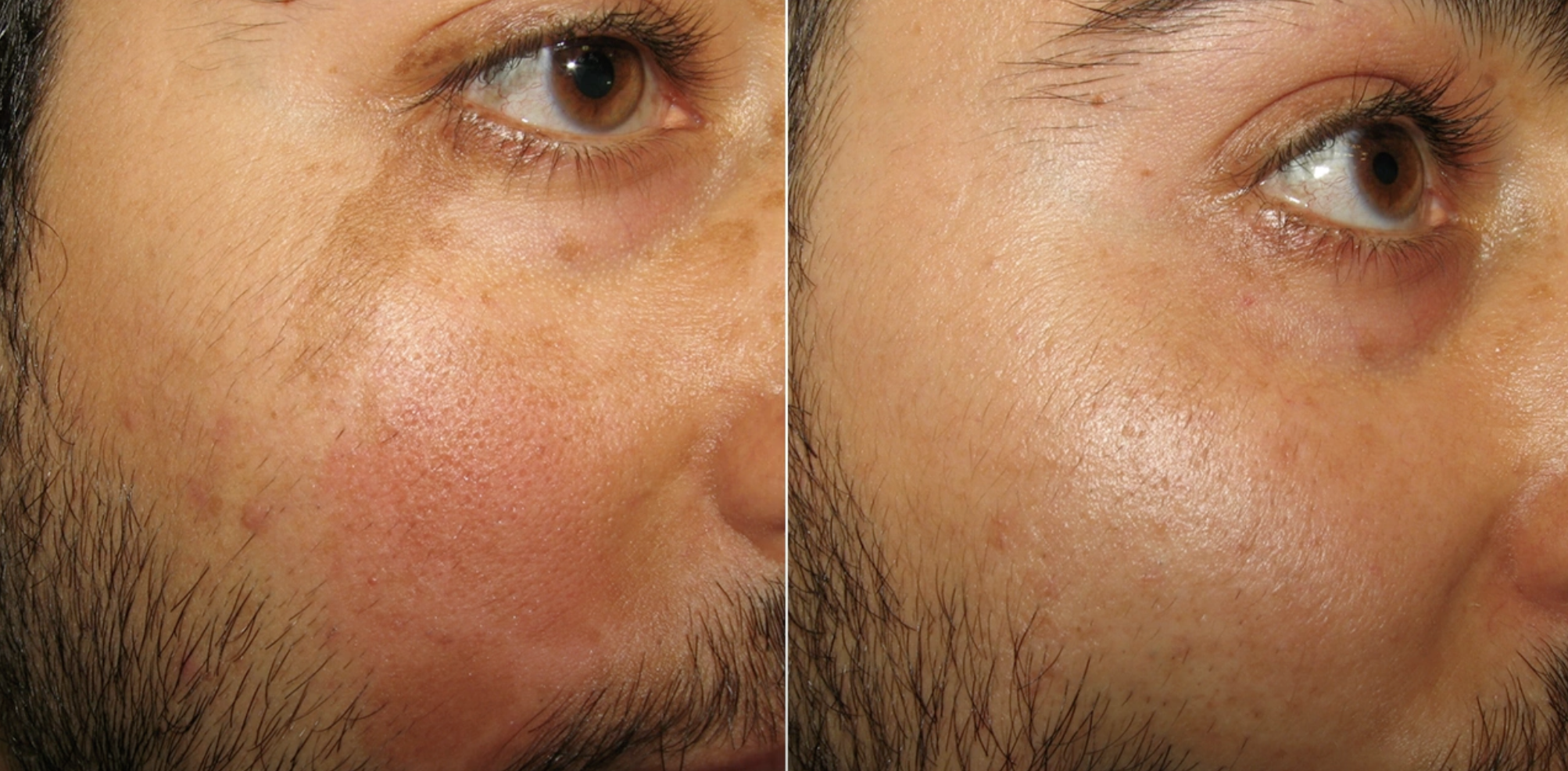 Pico Laser Hautverbesserung Vorher Nachher Dermatologie Hanau